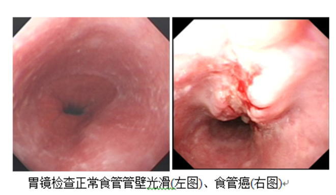 細(xì)胞免疫療法在晚期食管癌治療中的最新研究進(jìn)展