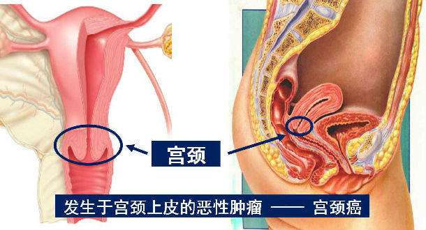 細(xì)胞免疫療法聯(lián)合放療干預(yù)晚期宮頸癌最新臨床研究