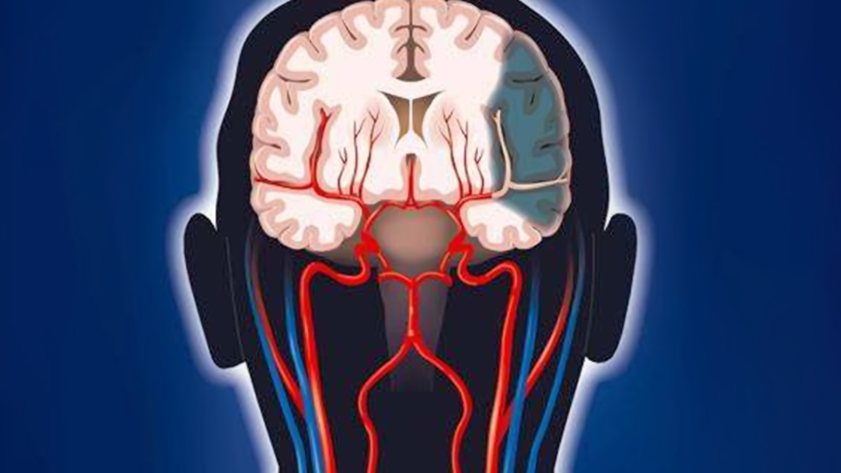 干細胞療法改善腦卒中的臨床案例：提高患者生活質(zhì)量