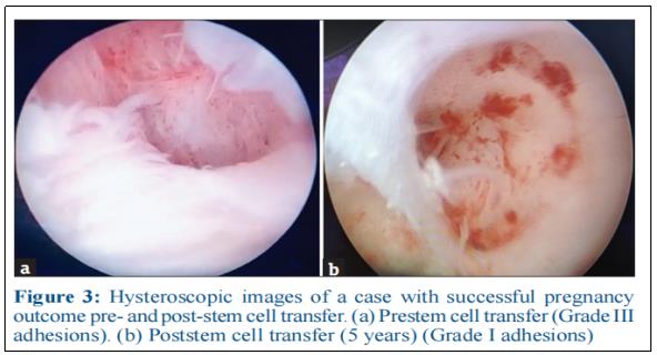 干細胞治療宮腔粘連和宮內(nèi)膜萎縮：5年隨訪研究