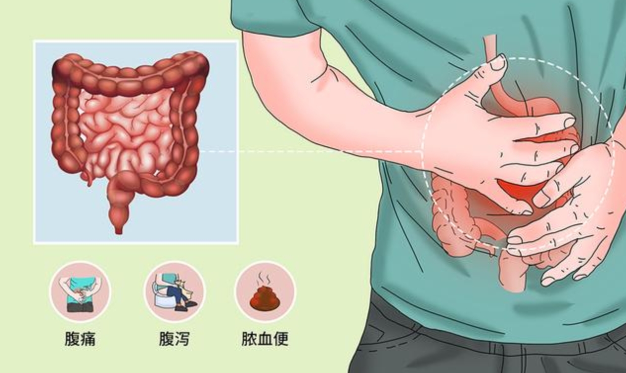 潰瘍性結(jié)腸炎