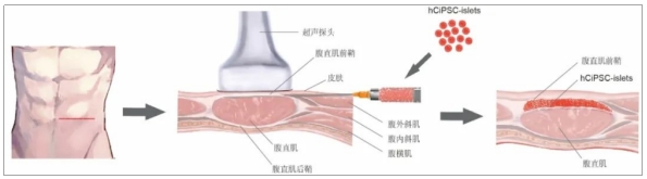 糖尿病臨床試驗